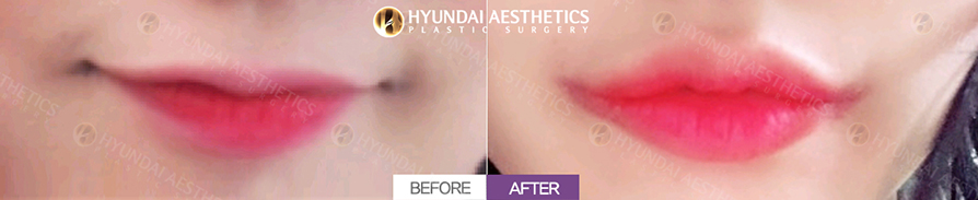 Mouth Corner Lift