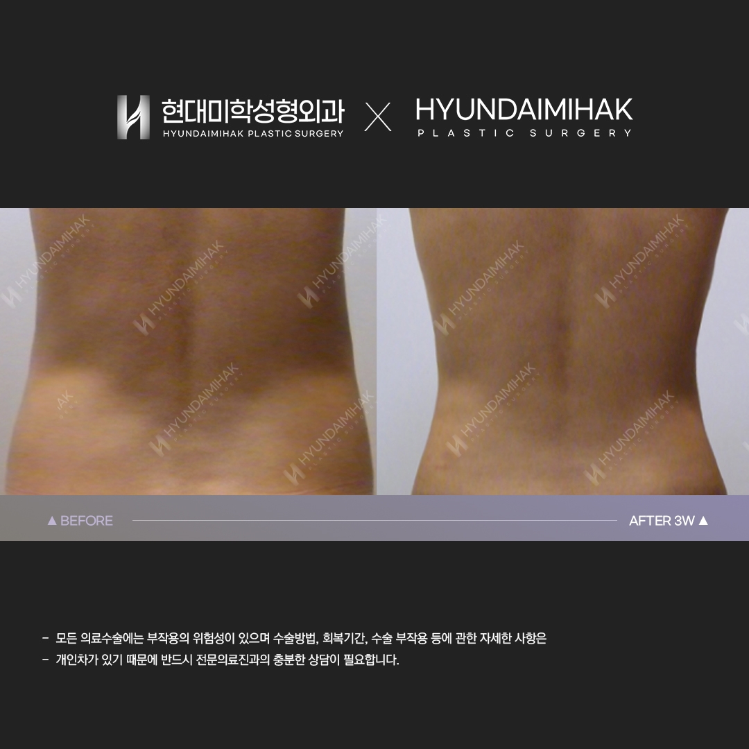 3 weeks after abdominal liposuction