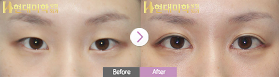 Eye Surgery, Non-Incisional Method, Inner, Outer, and Lower Canthoplasty