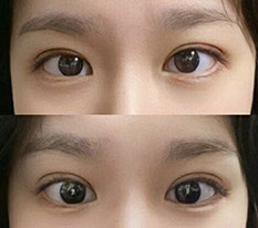 Got my natural adhesion double eyelid correction done