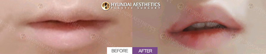 Mouth Corner Lift + Lateral Philtrum Expansion