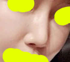 Nose revision totally mission success ~_~