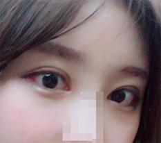 Double eyelid surgery — super satisfied!!