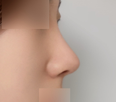 Hump nose surgery done