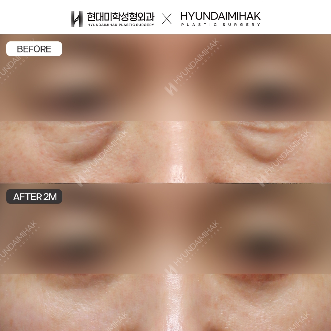 [Middle-aged Eye Surgery] Lower blepharoplasty + under-eye fat repositioning