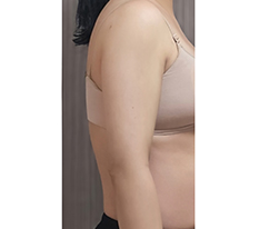 I trusted them and got liposuction