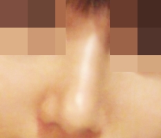 From a blob nose to a pretty nose