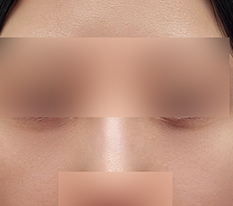 Under-eye fat repositioning seems amazing~