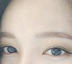 Eye surgery review☆.☆