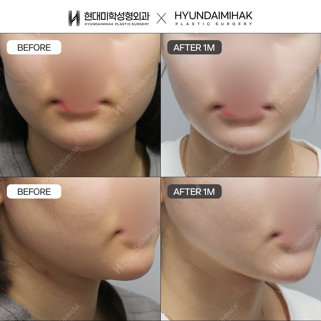 [Lifting] Double-chin thread lift, 1 month