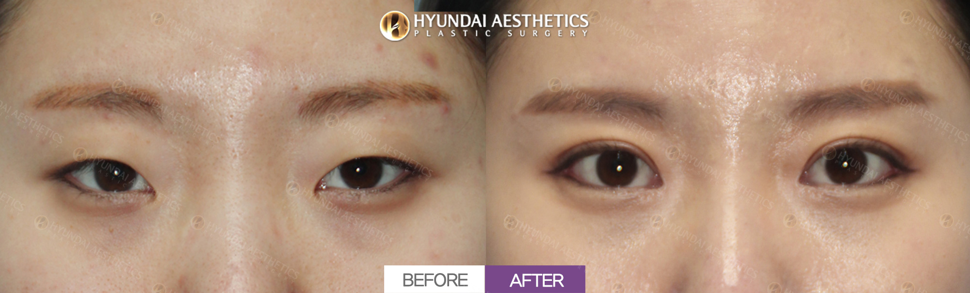 Epicanthoplasty + lateral canthoplasty + lower canthoplasty + incisional double eyelid surgery, 1 month