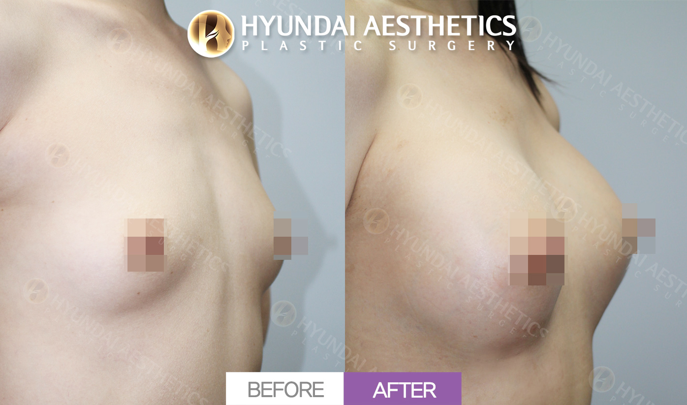 Breast Augmentation (Teardrop Implants)