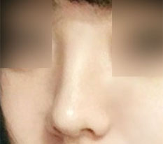 Goodbye to my round, unattractive nose