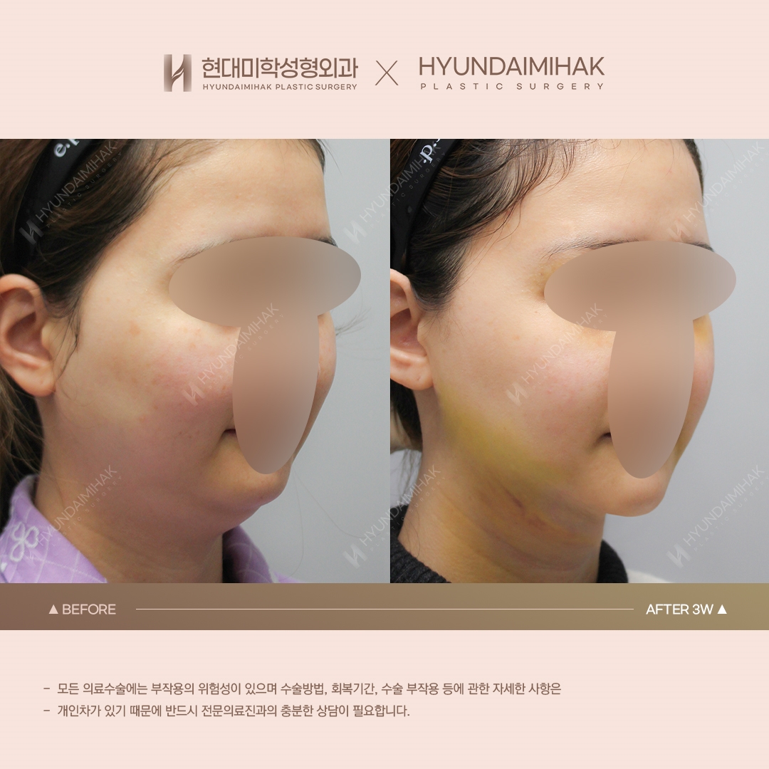 [Lifting] Double-Chin Thread Lift, Week 3