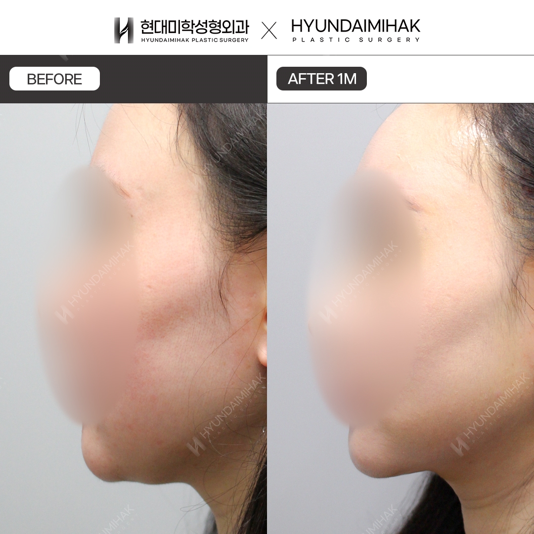 [Facial Rejuvenation] Thread Lift, 1 Month Later