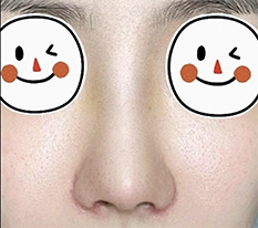 I had nose surgery, here is my review. It turned out so well ^^