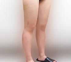 Lower-body obesity escape complete
