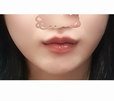 Corner Lift Surgery Instead of Botox