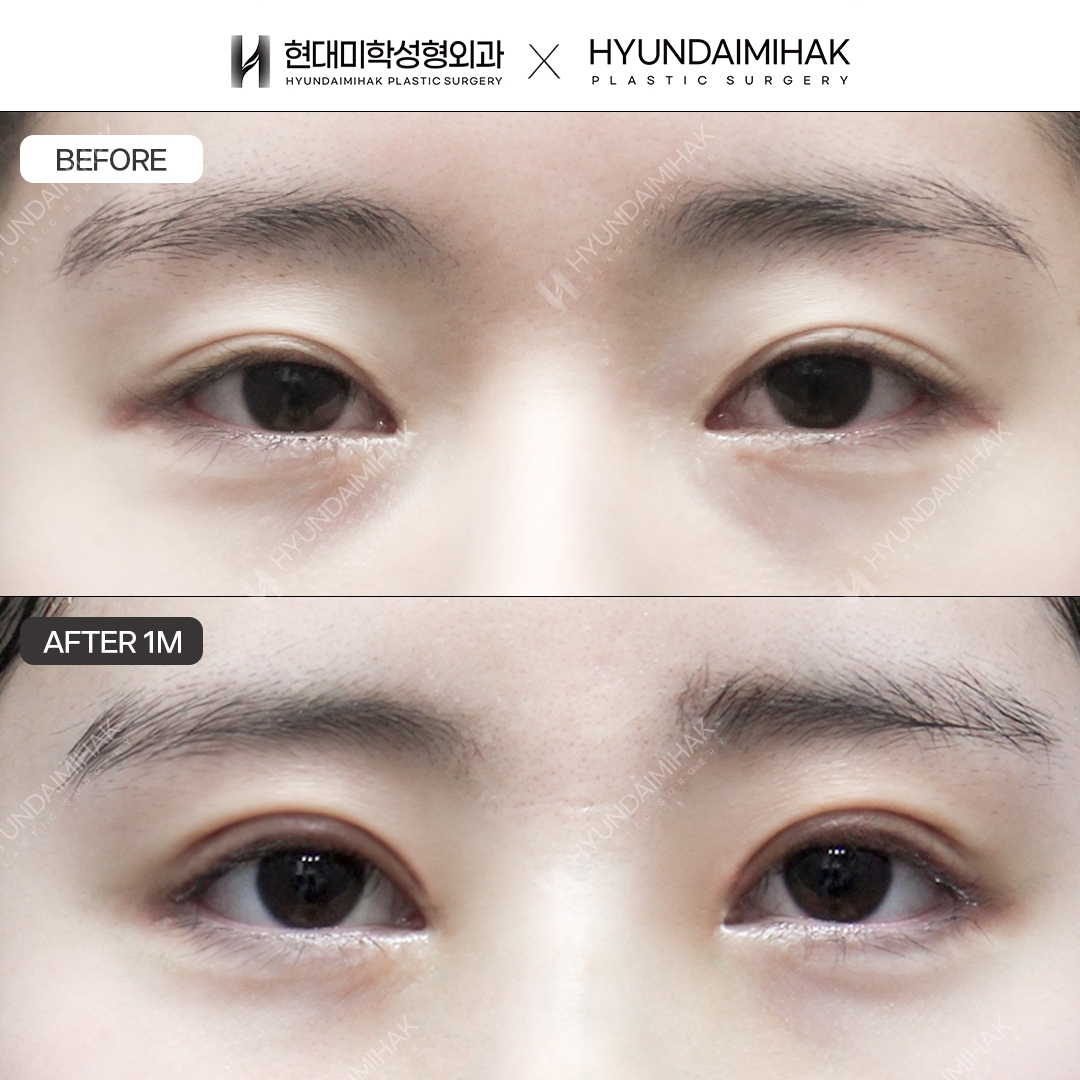 [Revision Eye Surgery] Incisional Double-Eyelid Revision + Dual Canthoplasty