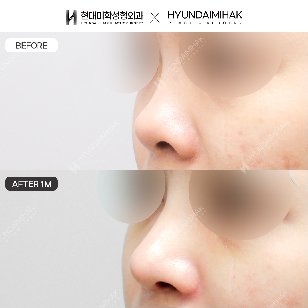 [Revision Rhinoplasty] Nasal bridge + nasal tip, 1 month post-op