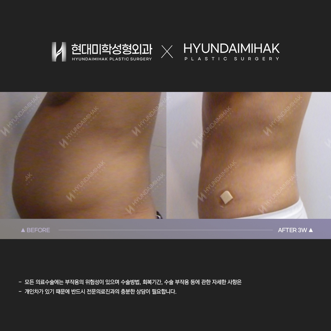 3 weeks after abdominal liposuction