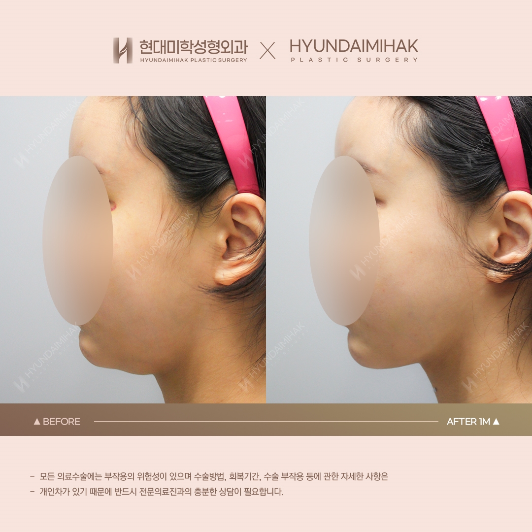 [Lifting] Double-Chin Thread Lift, 1 Month Post-Op