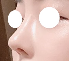I hear all the time that I got prettier thanks to my nose surgery