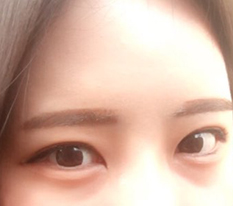 Review of outer + lower canthoplasty