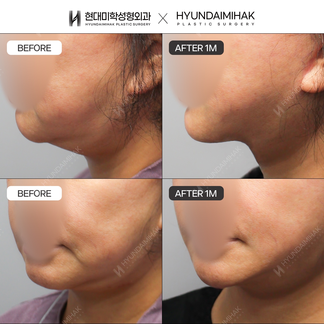 [Anti-Aging Surgery] Thread Lift, 1 Month Post-Op