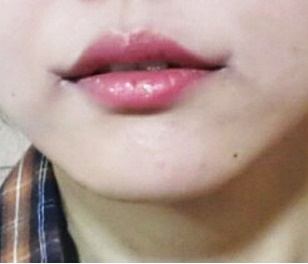 Lip corner surgery is amazing!!