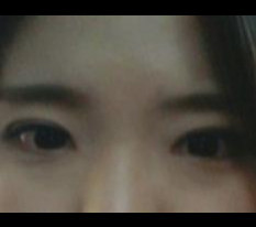 Got inner corner surgery and eye correction!