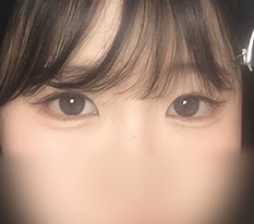Cooler outer and lower canthoplasty