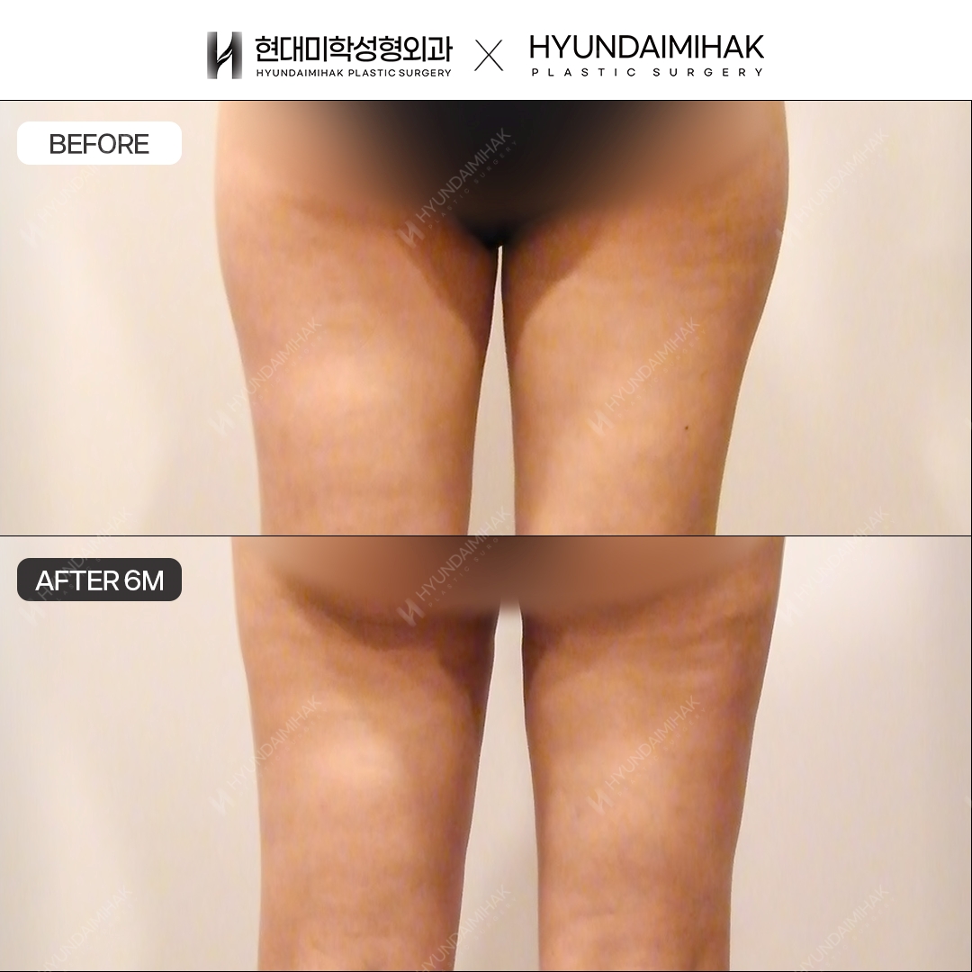 Thigh liposuction, 6 months post-op