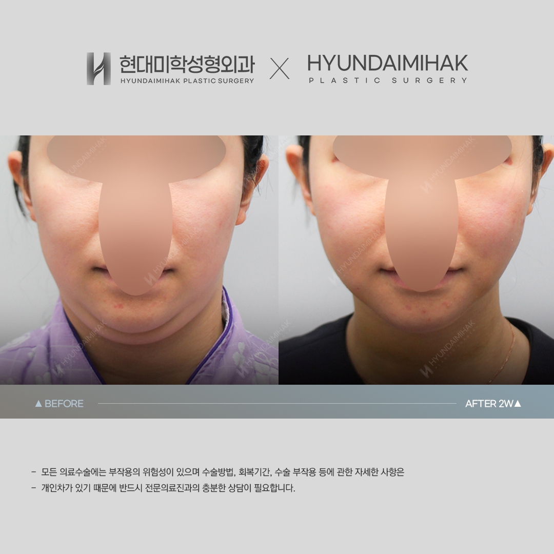 [Lifting] Double-Chin Thread Lift, Week 2