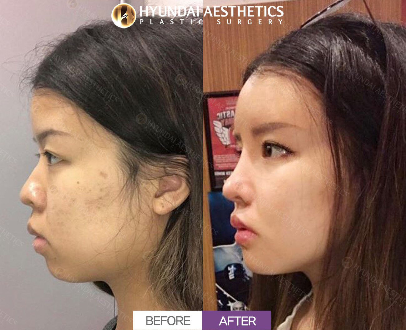 Fat Grafting, 1 Month