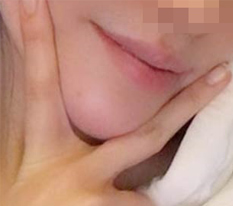 After chin-tip surgery, my face looks slimmer of course, and my whole image changed