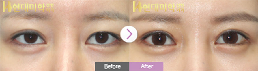 Revision Incisional Eye Surgery
