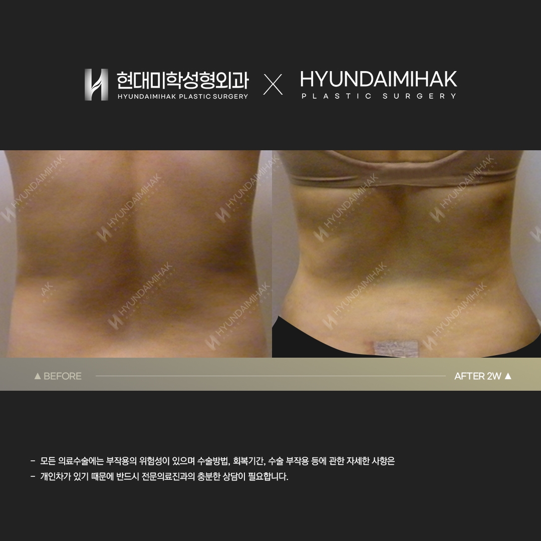 Abdominal Liposuction, Week 2