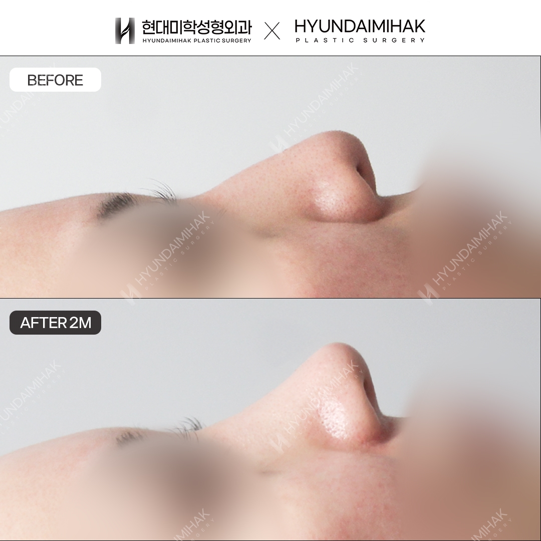 [Hump nose rhinoplasty] Nasal bridge + nasal tip, 2 months post-op
