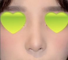 I had nose surgery, please tell me if it turned out well ^^