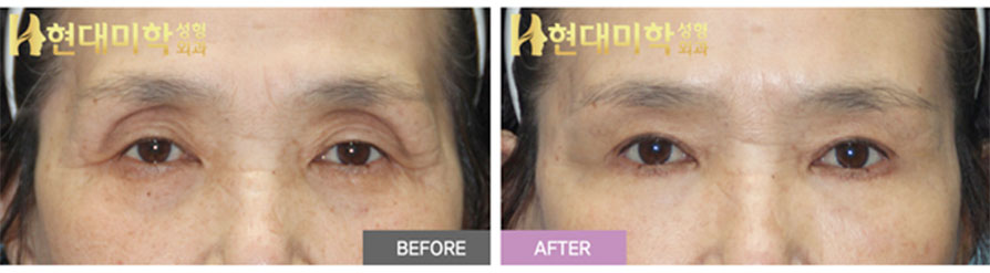 Upper Blepharoplasty, Ptosis Correction, Lower Blepharoplasty
