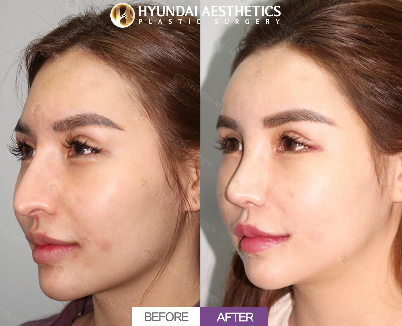 Revision Rhinoplasty, Day 7