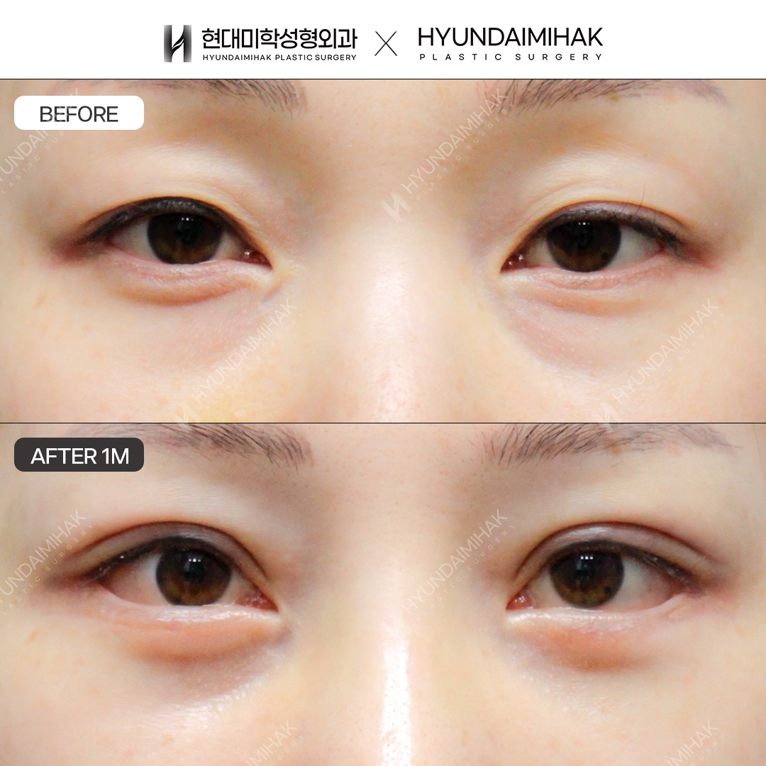 Incisional Double-Eyelid Surgery + Ptosis Correction + Dual Canthoplasty