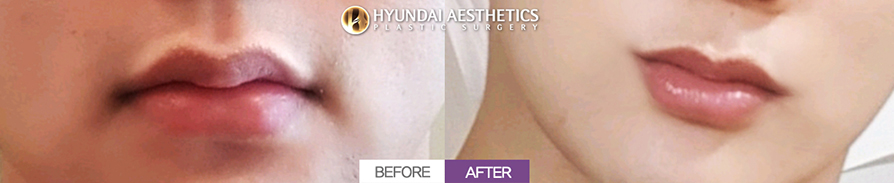 Mouth Corner Lift + Marionette Lines