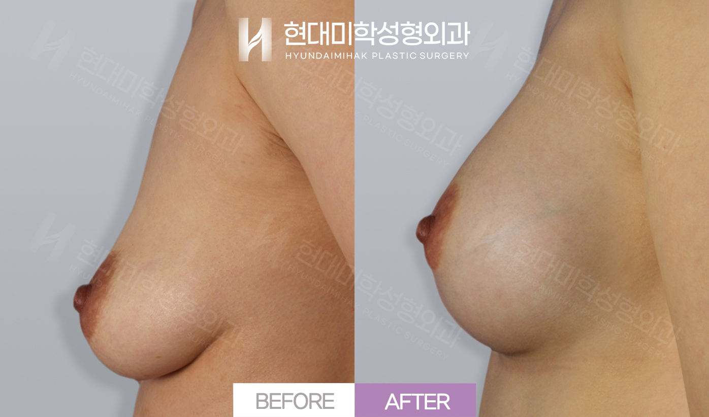 Breast Augmentation (Sagging Breasts)