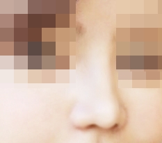 I love my nose surgery result