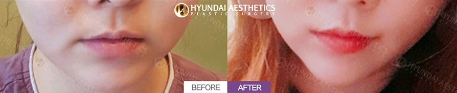 Mouth Corner Lift + Marionette Lines + Mouth Width Extension