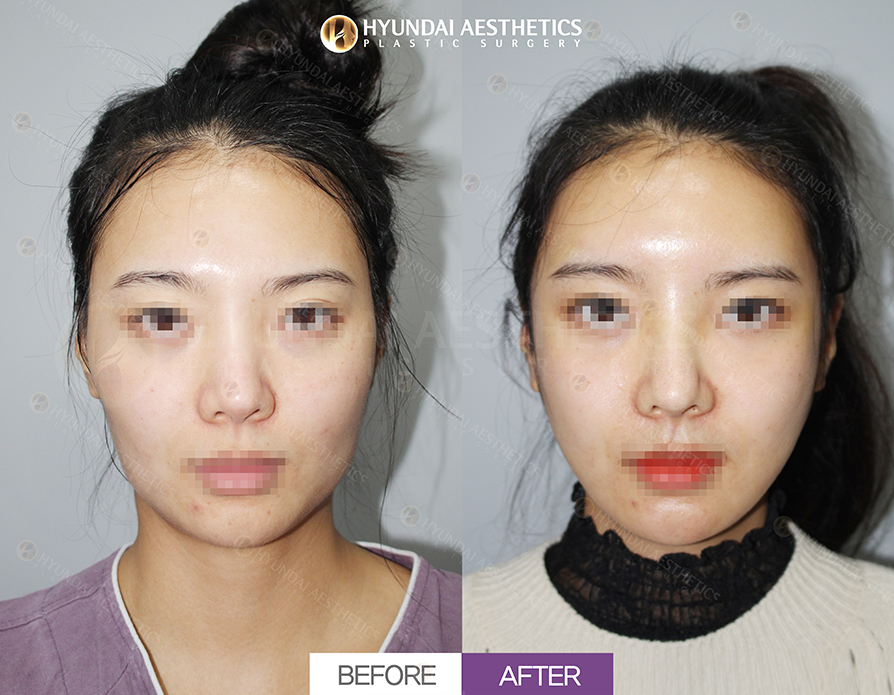 Cheekbone Reduction + Square Jaw Reduction