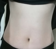 I Should Have Done Abdominal Lipo Sooner ㅠ