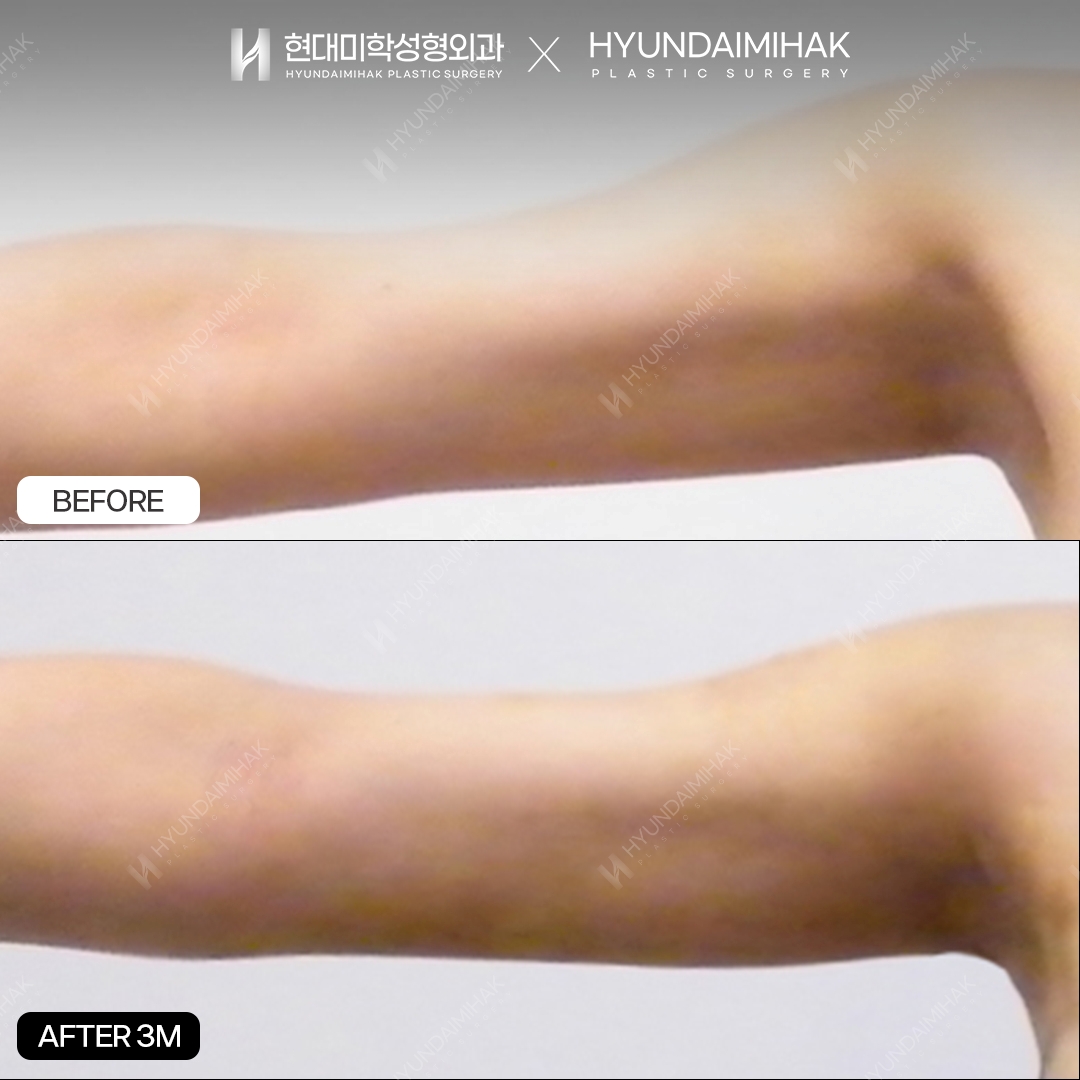 3 months after upper-arm liposuction